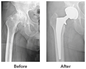 Direct Anterior Hip Replacement